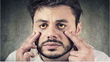 জন্ডিসের ৫ প্রধান কারণ ও লক্ষণ